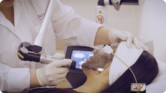 Carbon Laser Peel and the Many Names for One Popular Treatment