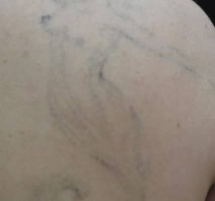Tattoo removal after