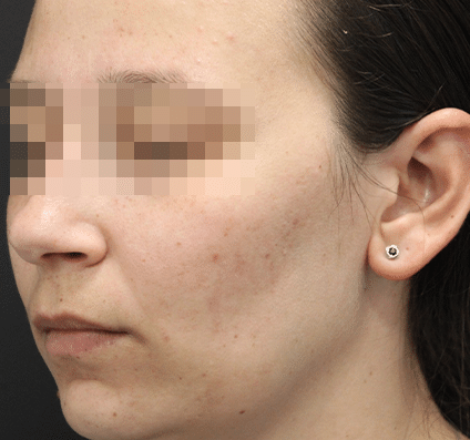Acne Scars after