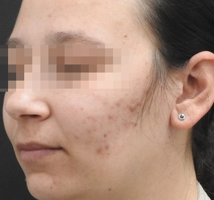 Acne scars before