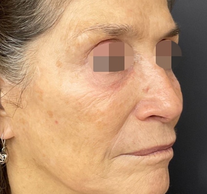 After winter reset treatment | Courtesy of Dr. Bermejo, Bermejo Clinic, Argentina
