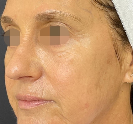 After winter reset treatment | Courtesy of Dr. Bermejo, Bermejo Clinic, Argentina