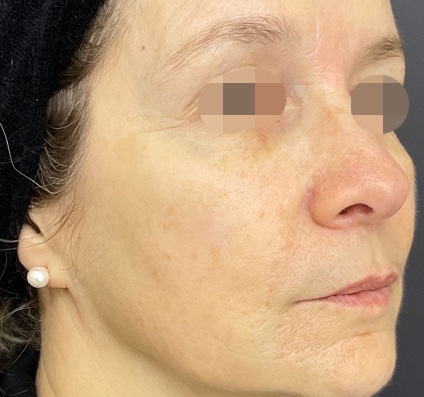 After winter reset treatment Courtesy of Dr. Bermejo, Bermejo Clinic, Argentina