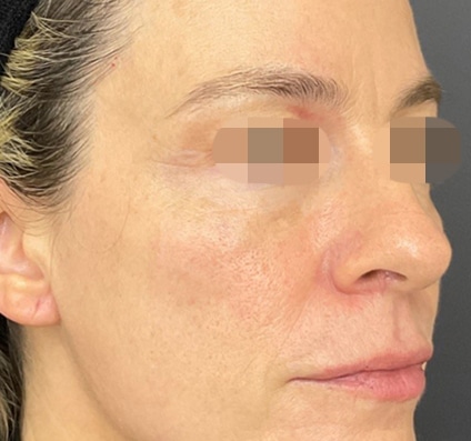 After winter reset treatment Courtesy of Dr. Bermejo, Bermejo Clinic, Argentina