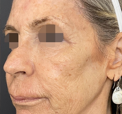 After winter reset treatment Courtesy of Dr. Bermejo, Bermejo Clinic, Argentina