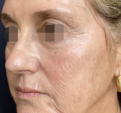 Before winter reset treatment | Courtesy of Dr. Bermejo, Bermejo Clinic, Argentina