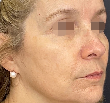 Before winter reset treatment | Courtesy of Dr. Bermejo, Bermejo Clinic, Argentina