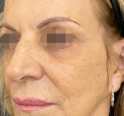 Before winter reset treatment Courtesy of Dr. Bermejo, Bermejo Clinic, Argentina