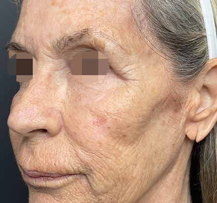 Before winter reset treatment Courtesy of Dr. Bermejo, Bermejo Clinic, Argentina