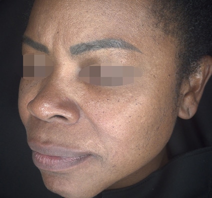 After Pixel Peel treatment Courtesy of Alma’s Clinical Department