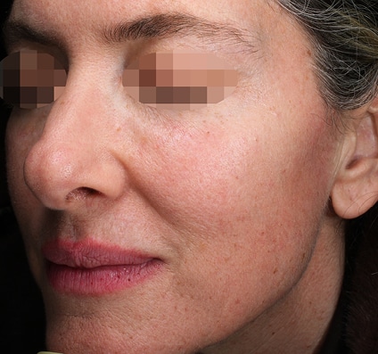 After Pixel Peel treatment Courtesy of Prof. Ofir Artzi