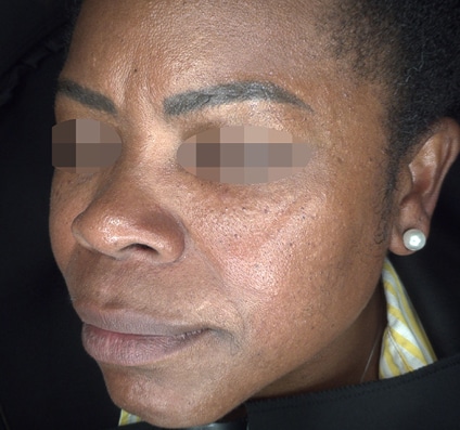 Before Pixel Peel treatment Courtesy of Alma’s Clinical Department