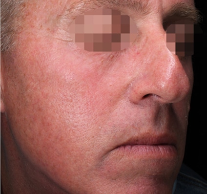 After winter reset treatment | Courtesy of Prof. Ofir Artzi
